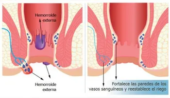 Luego de este remedio no tendrás que ir al quirófano a operar tus hemorroides