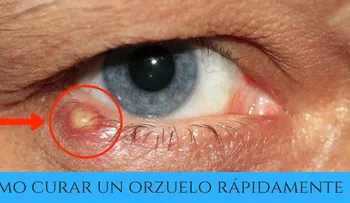Cómo curar un orzuelo en el ojo? Causas y remedios