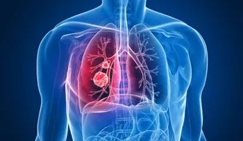 Cuba lanza la primera vacuna contra el cáncer de pulmón