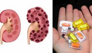 Estas son las 10 pastillas que acaban con tus riñones y casi nadie lo sabe. Los médicos siempre las recetan!