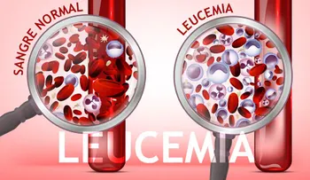 La leucemia tiene cura; 10 mitos y verdades para tratar esta enfermedad 