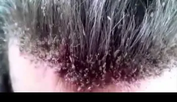 ¡Insólito! Este podría ser el peor caso de un hombre con piojos (VIDEO)