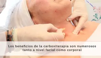 Los beneficios de la carboxiterapia