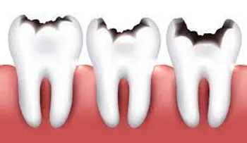 Cómo revertir el proceso de deterioro de los dientes y evitar que se forme una caries dental