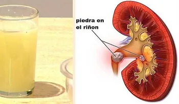 Así es como sale expulsada hasta la ultima piedra del Riñón con beber media taza de esta bebida