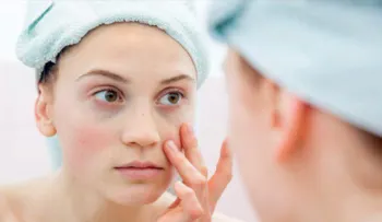Ojeras y bolsas: ¿Por qué salen y cómo eliminarlas?