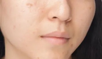 Estos 7 hábitos alimenticios están dañando tu rostro