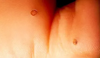¿Se puede contagiar el Vírus del Papiloma Humano con el sexo oral?