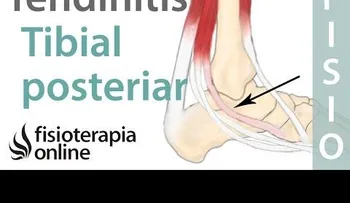 Ejercicios para la tendinitis tibial Posterial (VIDEO)