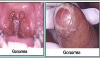 Consecuencias de una gonorrea, explicada por un experto