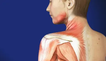 Síndrome del Dolor Miofascial y la fibromialgia