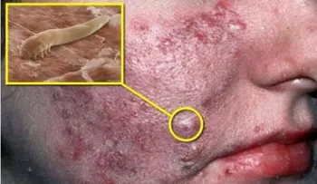 Esta pequeña criatura de fea apariencia, vive en tu cuerpo justo en laâ?¦