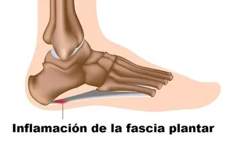 Fascitis plantar prevención y tratamientos en casa