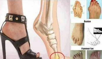 Zapatos de tacón alto causan deformaciones en pies