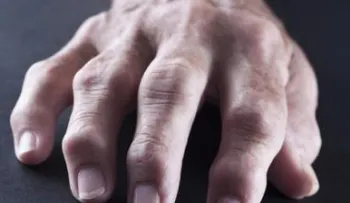 Descubren nueva forma tratar la artritis con un solo día en hospital