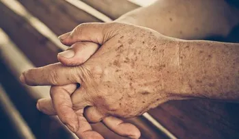 Manchas de la edad y cómo prevenirlas
