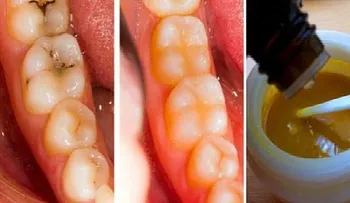 Revierte las caries con estas potentes mascaras para tus dientes
