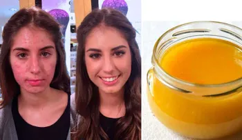 Esta fruta elimina de por vida el acné y espinillas. INCREIBLE!