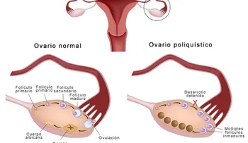 Curar el síndrome de ovario poliquístico