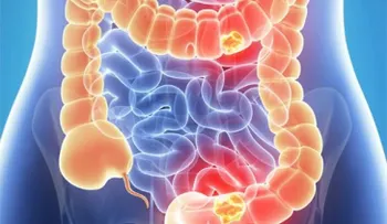 Las ventajas de detectar el cáncer de colon a los 50 años
