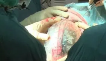 Médicos holandeses implantan por primera vez un cráneo de plástico impreso en 3D