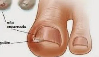 Estos trucos sencillos te salvarán para simpre de las dolorosas uñas encarnadas 