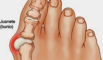 ¿Cómo deshacerse de juanetes en los pies
