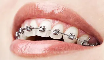 En realidad los aparatos son malos para los dientes y tu salud bucal