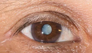Gotas en los ojos podrían ser la solución para curar las cataratas