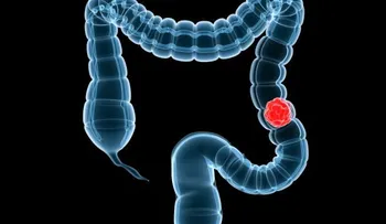 Aprueban examen contra cáncer de colon en EEUU 