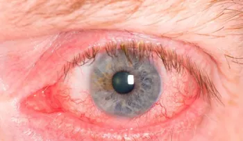  Cómo eliminar naturalmente el enrojecimiento de los ojos. 