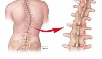 Cambios degenerativos en la columna vertebral: ¿Artritis?