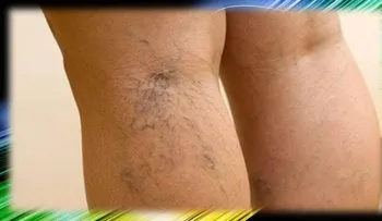 Remedio para quitar las varices en las piernas 