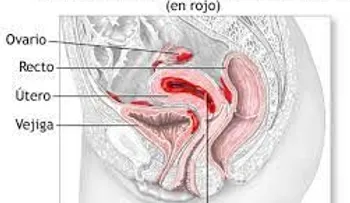 Analgésicos para la endometriosis: ibuprofeno (Advil, Motrin IB, otros) o naproxeno sódico (Aleve)