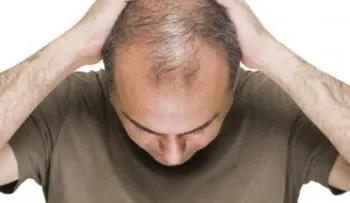 Descubren los genes que nos dejan calvos