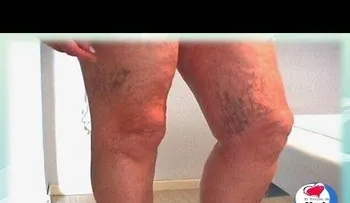 Remedios naturales para las varices y arañitas en las piernas (venas varicosas)