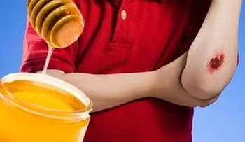 Poner miel a las heridas ayuda a curarlas más rápido y detiene el crecimiento de bacterias  