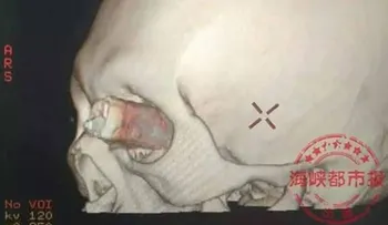 IMAGENES FUERTES: Un hombre llegó a un hospital de China con un cuchillo clavado en un ojo