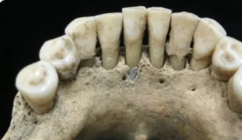 Pigmento azul en los dientes revela una cualidad de las mujeres medievales