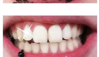 Limpiar los dientes con carbón no es todo lo que crees!