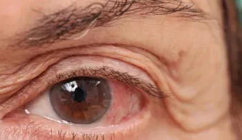 Ojo seco es un problema de salud que afecta a mujeres en la menopausia