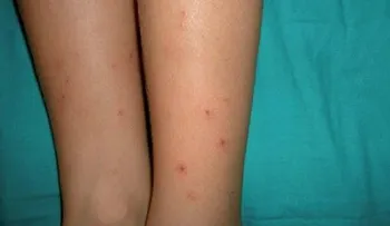 Nicaragua en alerta extrema sanitaria por chikungunya