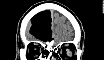 Médicos hallan una bolsa de aire en el cerebro de un hombre