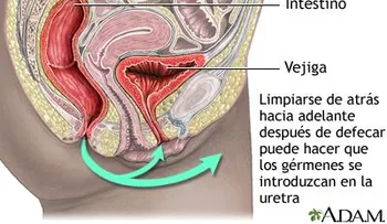 ¿Cuáles son las causas de la infección del tracto urinario?
