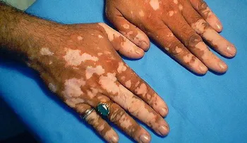 Médicos descubren cura para el vitiligo: El mundo celebra 
