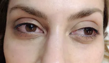 Elimina tus ojeras con este remedio 