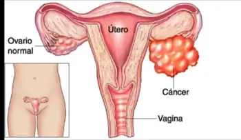 Estos son los dos síntomas más comunes del cáncer de ovarios