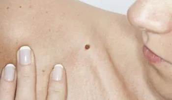 La combinación de dos nuevas moléculas frena el cáncer de ovario 