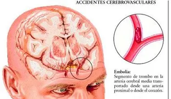 La demencia vascular: síntomas, diagnóstico y tratamiento  (VIDEO)