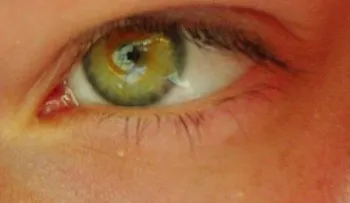 Cómo elaborar una crema para eliminar ojeras y bolsas